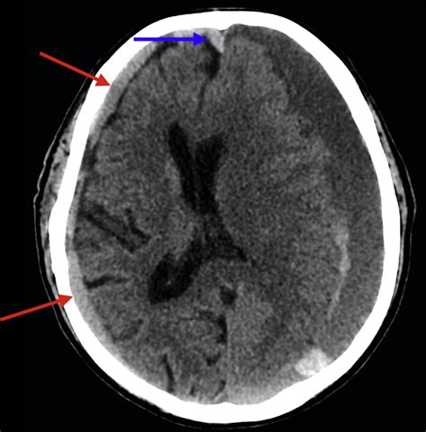 Chronic subdural hematomas can be slow to heal - Salinas …