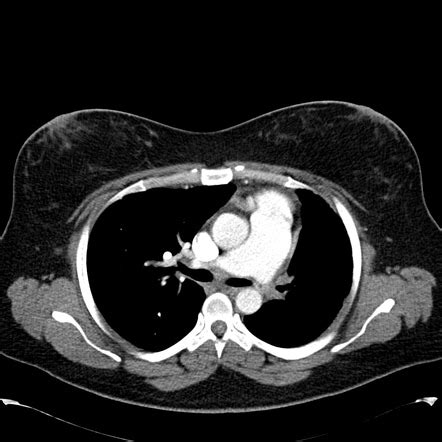 Chronic thromboembolic pulmonary hypertension - Radiopaedia