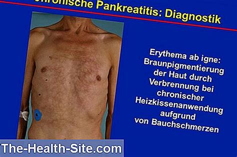 Chronische Pancreatitis: Prognose, Risicofactoren, …