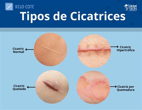 Cicatrices