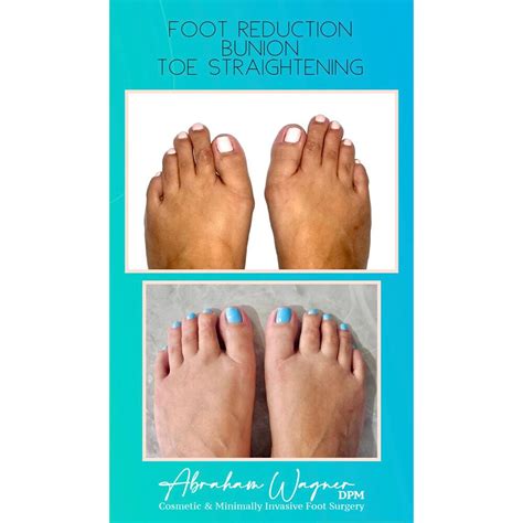 Cinderella foot surgery before and after. .  <a href=https://ekodrev-rp.ru/ddraj/parkeerb...