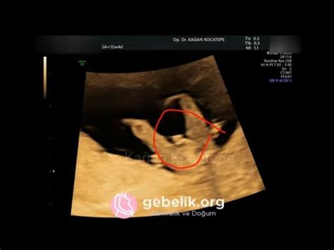 Cinsiyet 12 haftalık erkek bebek ultrason görüntüleri
