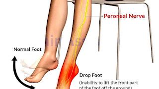 Circuits Diagram For Nerve Potential Of A Foot Drop Foot Dro