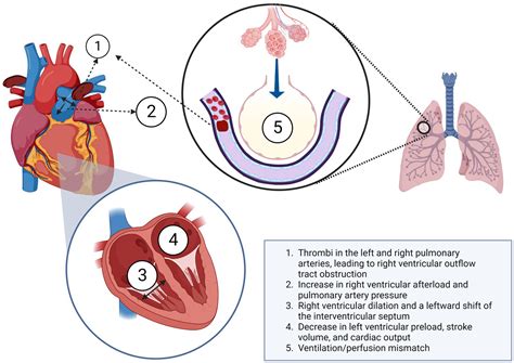 Circulatory failure in acute pulmonary embolism - PubMed