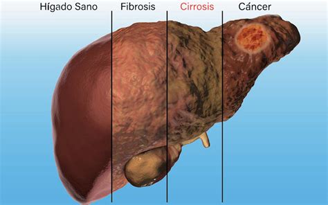 Cirrosis hepática: qué es, causas, síntomas y …