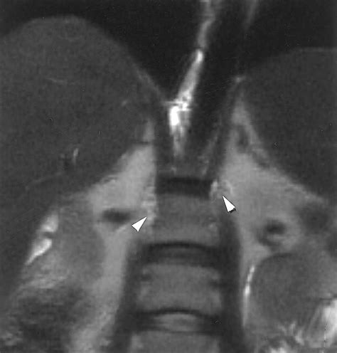 Cisterna Chyli at Routine Abdominal MR Imaging: A Normal …