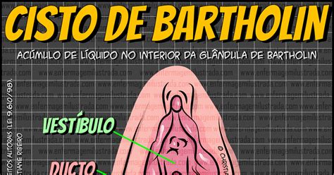 Cisto de Bartholin / Bartholin