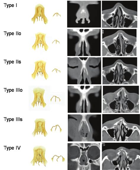 Classification of nasal bone fracture. Download Scientific Diagram