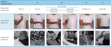 Classification of posture in poststroke upper limb spasticity a