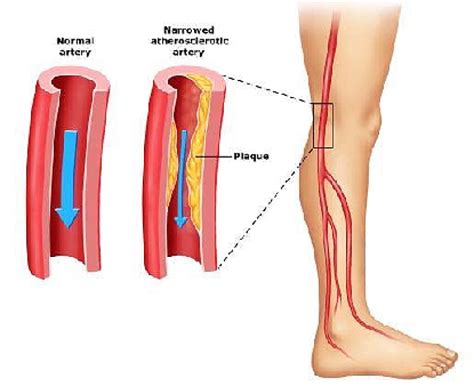 Claudicatio behandling