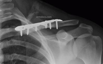 Clavicle Fracture Fixation Rehab Protocol Melbourne Arm Clinic