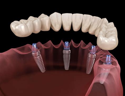 ClearChoice: Dental Implants in the Los Angeles Area