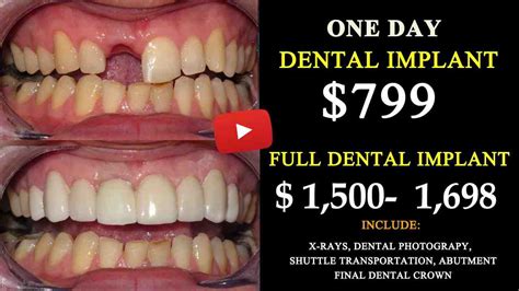 Clearchoice dental implants cost. Periodontal disease, injury and decay are some of the most common reasons that seniors lose their teeth. One alternative that seniors can use to restore their smiles is dental impl... 