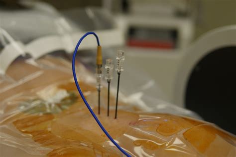 Cleveland Pain Care Radio Frequency Ablation