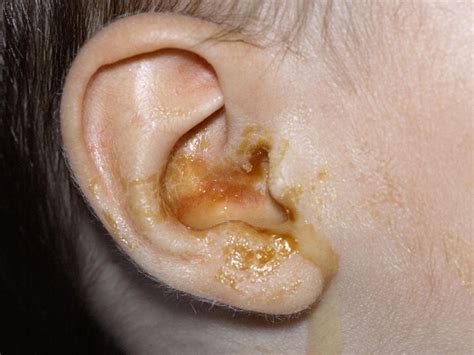 Clinical Consultation: Symptom: Ear Drainage for Three Month