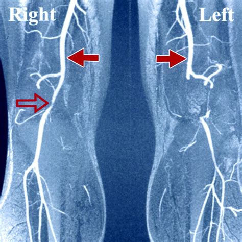 Clinical Evaluation and MR Imaging Features of Popliteal Artery ...