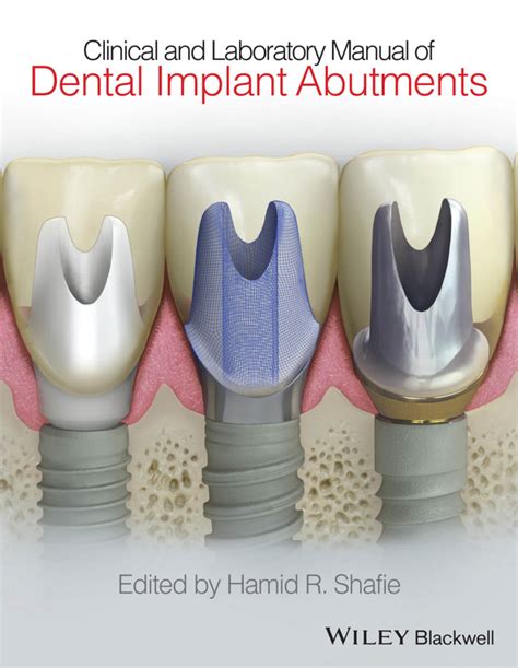 Clinical and laboratory manual of dental implant abutments by hamid r shafie. - Introduction to graph theory solutions manual wilson.