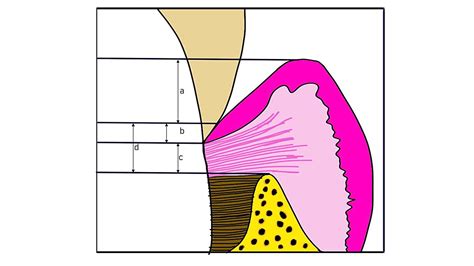 Clinical evaluation of the biological width following …