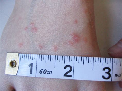 Close up pictures of chigger bites. They may have a hard scab in the center. (Redness can be more difficult to see on dark skin.) Bites also can show up as clusters, but usually where clothing meets skin. Like bed bug bites, chigger bites can be intensely itchy, especially for the first 24 to 48 hours, according to the Cleveland Clinic. It may take up to two weeks to become itch ... 