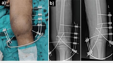 Closed Reduction and Internal Fixation of Completely Displaced …