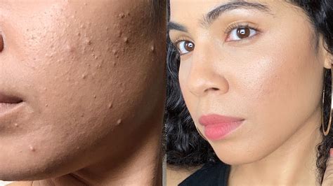 Closed comedones before and after.  #skin1004 #retinol #centella #koreanskin...