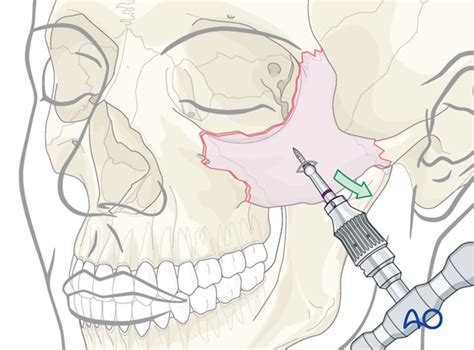 Closed treatment for Zygoma, zygomatic complex fracture - AO …