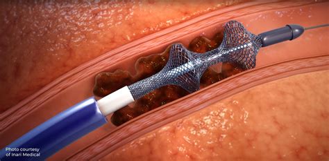 Clot removal beyond normal treatment time, still improved quality …