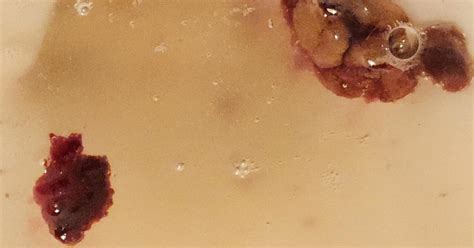 Clots in poo