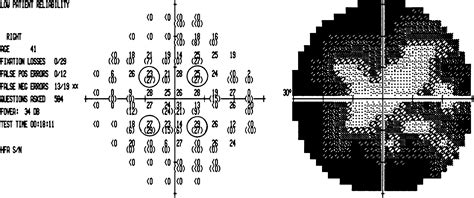 Cloverleaf visual field - American Academy of Ophthalmology