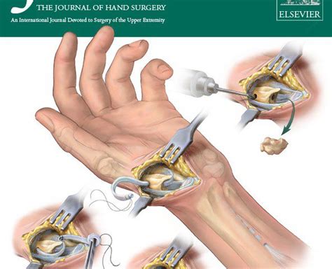 Cmc arthroplasty cpt. The third and final aspect of the survey was an open-ended question to determine the surgical procedure most commonly seen by the practitioner. Special instructions included the discontinuation of the survey should the therapist not administer therapy to a patient population that included thumb CMC joint arthroplasty. ... Following … 