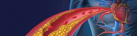 Co je ateroskleroza