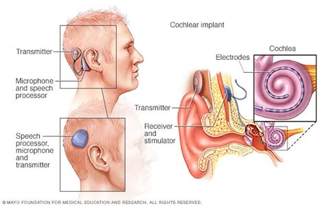 Cochlear implants - Mayo Clinic (2026)