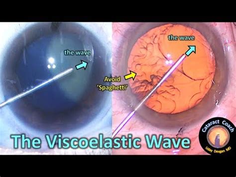 Coding Top 10: Viscoelastic for Complex Cataract Surgery, …