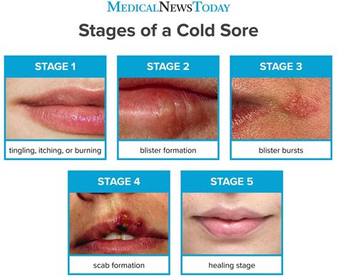 Cold Sore Stages (with Pictures) - The 5 Stages of Cold Sore Outbreak