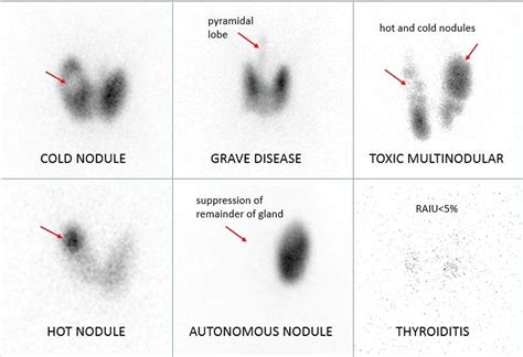 Cold nodule in thyroid scan.  Nodules that make too much thyroid hormone, called hot no...