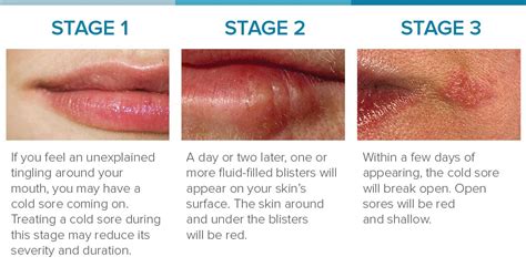 Cold sore stages pictures. For cold sores, symptoms appear in stages, beginning with redness, inflammation, and discomfort. Angular cheilitis has less defined stages with more overlap of various symptoms. 