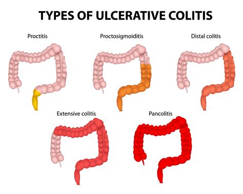 Colitis ulcerosa rygning