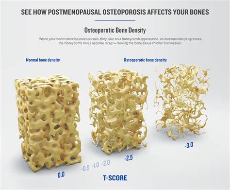 Collagen and Bone Density