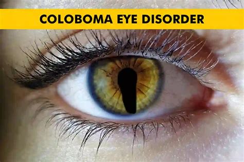 Coloboma