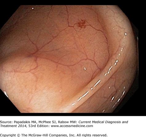 Colon angioectasia icd 10. Research online indicates gastrointestinal angioectasia are the most common gastrointestinal tract vascular anomaly and are characterized by ectatic, dilated, … 