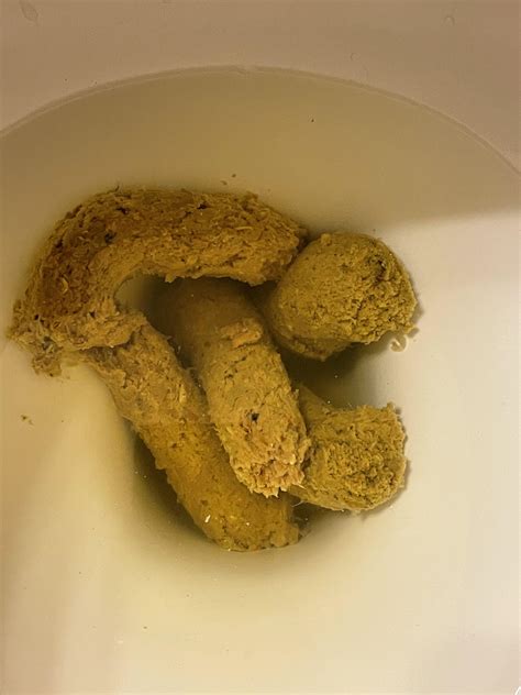 Colon cancer pictures of black specks in stool. Sep 3, 2019 · Hard or infrequent stools. This signifies constipation and is usually caused by a lack of fiber in your diet, as well as low water intake. However, this issue may also be caused by medications, blockages in the intestine, or in more rare cases, colon cancer. “Constipation can be treated in many ways and I always begin with increasing fiber ... 