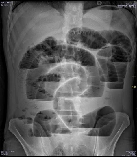 Occlusion of colon or intestine NOS. Stenosis of colon or intestine NOS. Stricture of colon or intestine NOS. Other intestinal obstruction. ICD-10-CM K56.691 is grouped within Diagnostic Related Group (s) (MS-DRG v41.0): 388 Gastrointestinal obstruction with mcc. 389 Gastrointestinal obstruction with cc.. 
