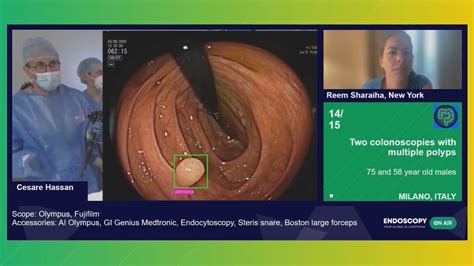 Colonoscopy and Colonoscopic Polypectomy Using Side-viewing …