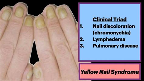 Color java.  Yellow nail syndrome may be a symptom of a lung disease, such as chronic...