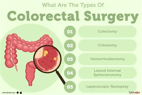 Colorectal Cancer Surgery Types Procedures and FAQs
