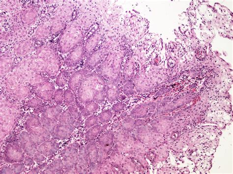 Colposcopy of Normal Cervix Squamous Metaplasia - ASCCP