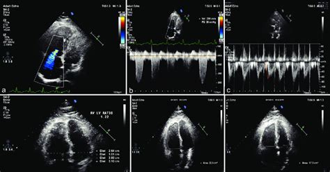 Combination of echocardiography and emergency …