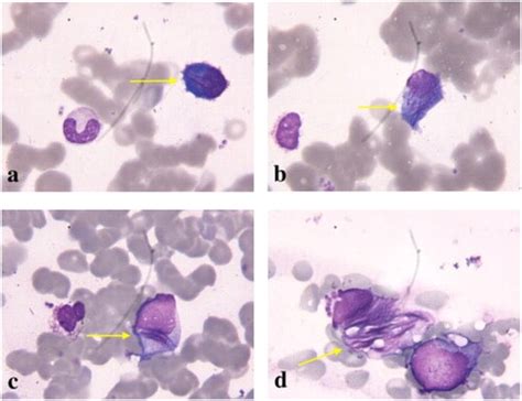 Combined light chain crystalline tubulopathy, podocytopathy, and ...