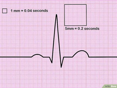 Come Leggere un ECG: 9 Passaggi (con Immagini)