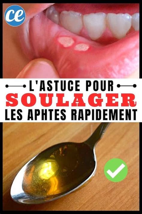 th?q=Comment+enlever+un+aphte+très+vite